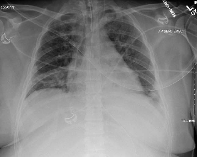 Chest radiograph of adult patient with enterovirus D68–associated acute respiratory distress syndrome -Kristine M. Wylie